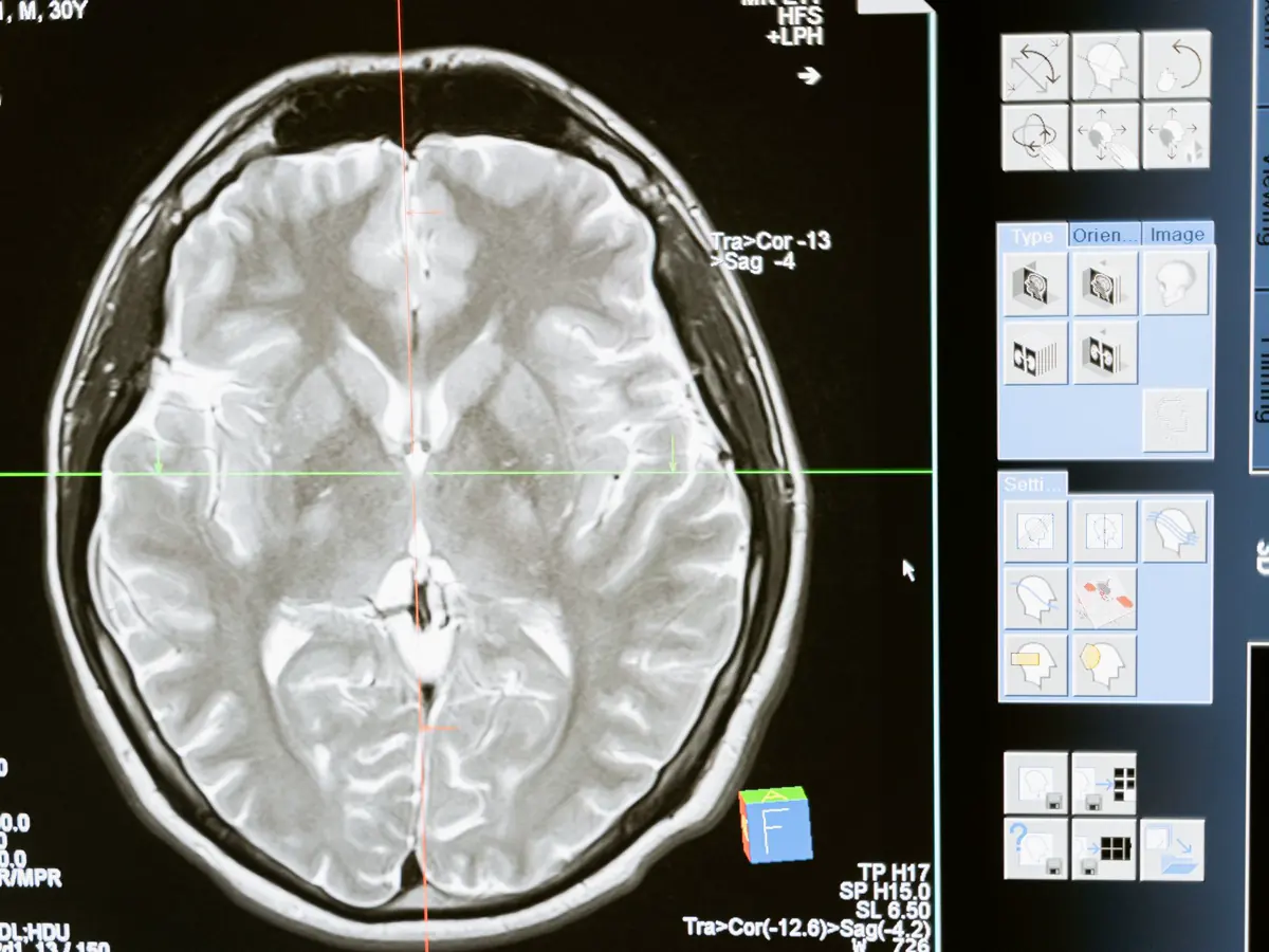 A brain MRI scan displayed on a clinical monitor